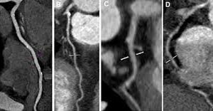 SIEMENS DEFINITION 128 (DUAL SOURCE)